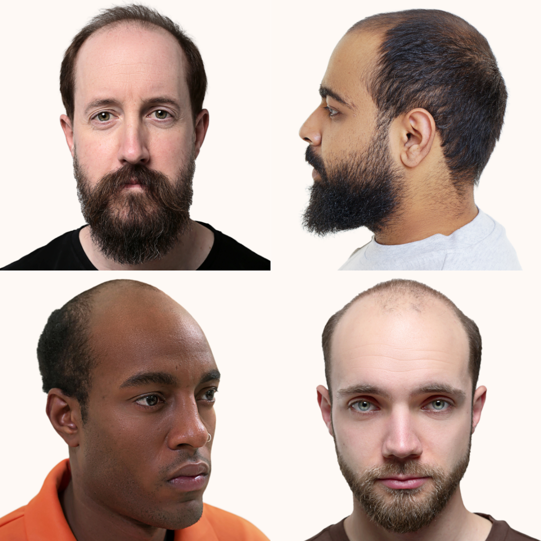 The Pattern of Male Balding