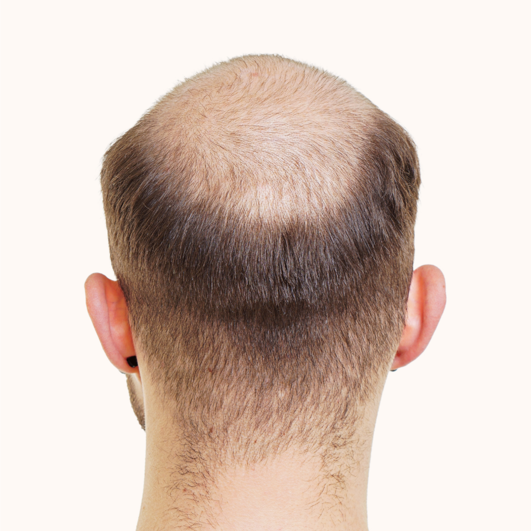 Why are men losing their hair younger than ever?