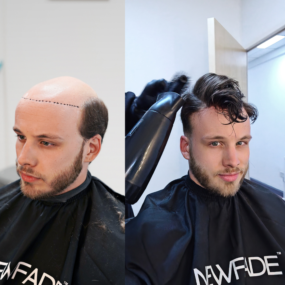 Before picture on left with client's bald hair and after picture of clent with a fuller hair